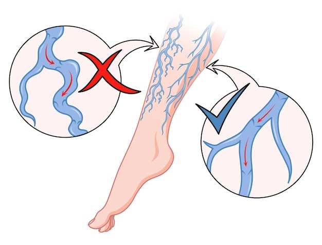 Профилактика и лечение бляшек в артериях нижних конечностей