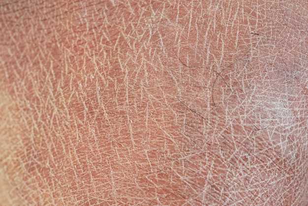 Особенности высыпаний при кори и их отличия от других кожных заболеваний