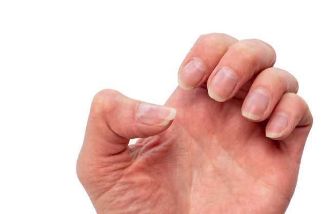 Основные причины гноения вросшего ногтя